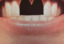 missing teeth (and originality?) / Pan dans les dents!